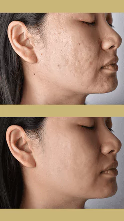Skin111