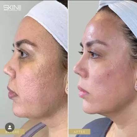 Skin111