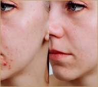 Skin111