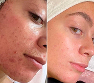 Skin111