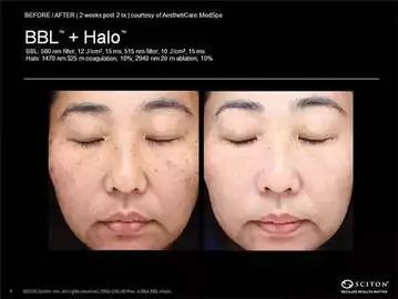 Skin111
