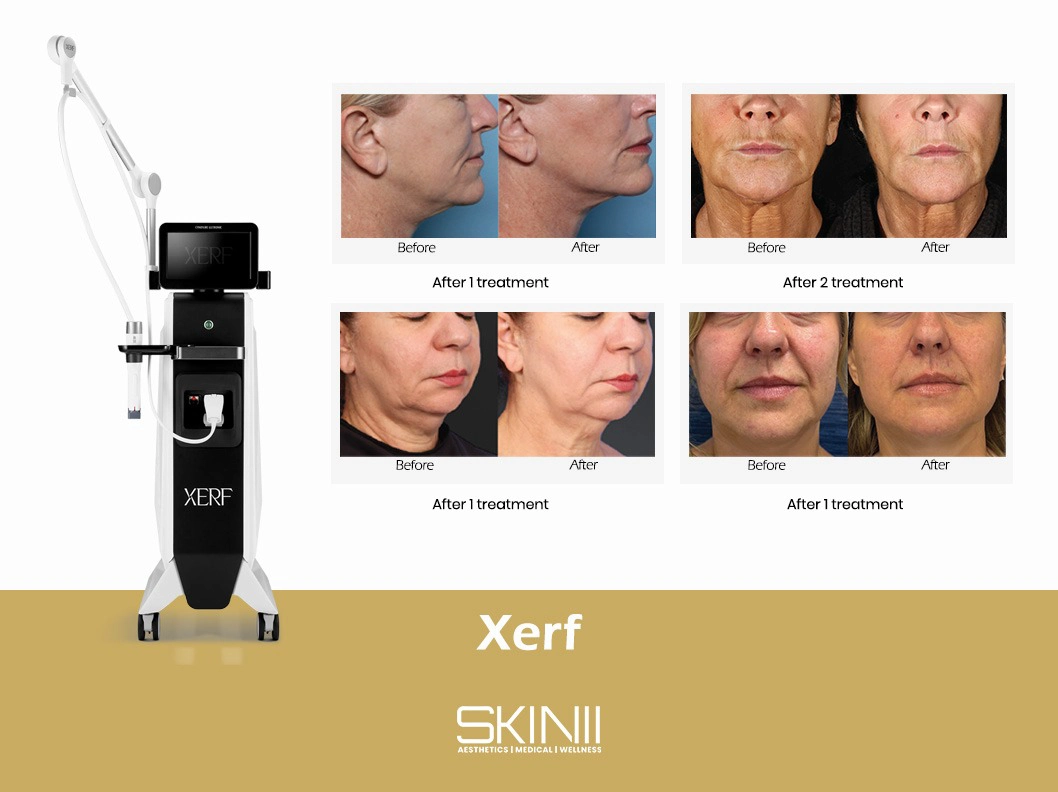 Skin111